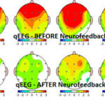 Neurofeedback Before & After mirasol.net
